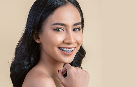 How do I know if I need braces? 10 signs and symptoms to look for